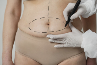 Liposuzione a 360°: Spiegazione dell'Intera Modellatura del Corpo