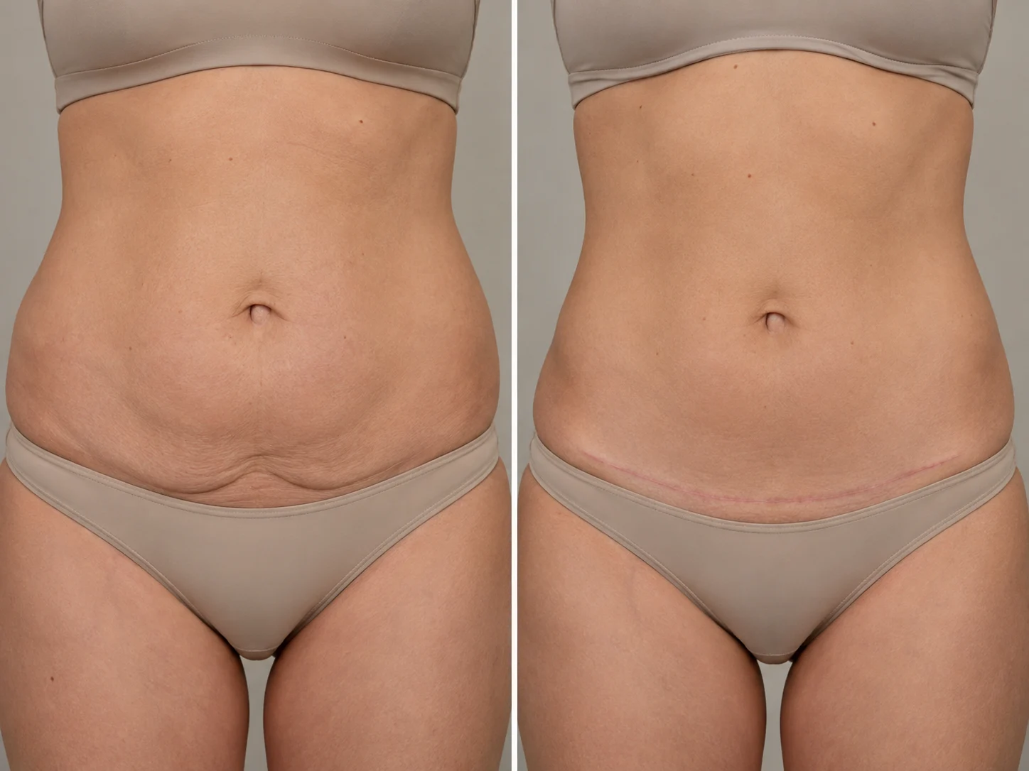 how does a tummy tuck change your body before and after