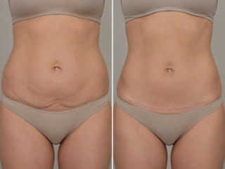 how does a tummy tuck change your body before and after