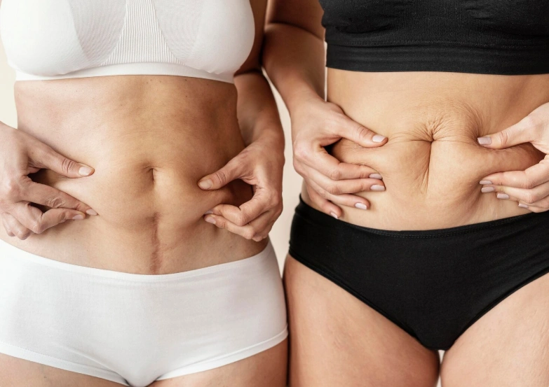 Abdominoplasty vs. Liposuction: Key Differences Explained