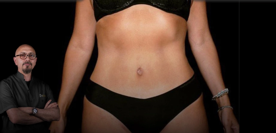 What Is a Tummy Tuck? Procedure, Benefits, Risks & Recovery