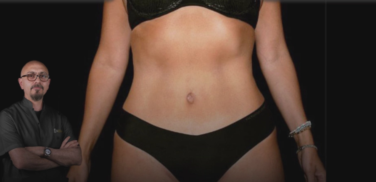 What Is a Tummy Tuck? Procedure, Benefits, Risks & Recovery