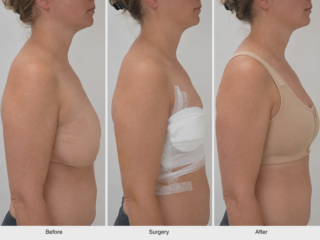 breast lift before surgery after comparison