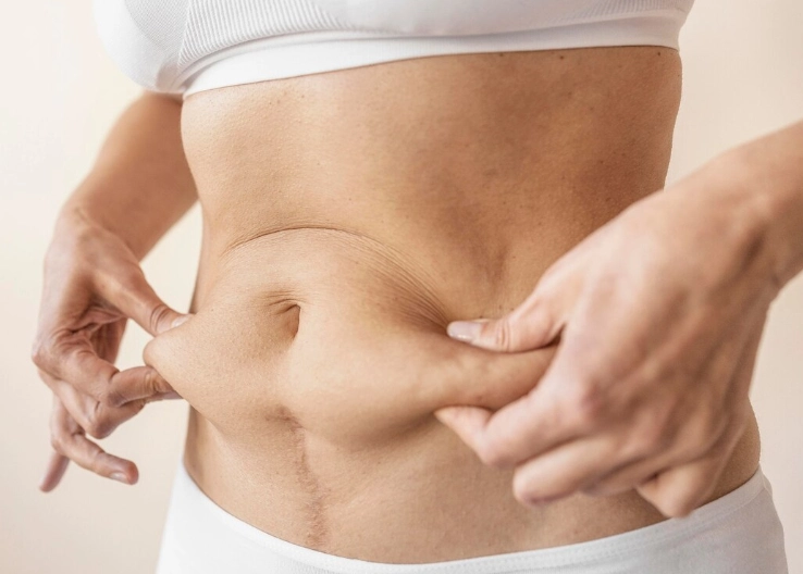 Does Fat Come Back After Liposuction?