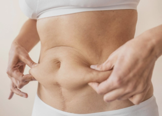 ¿Vuelve la grasa después de la liposucción