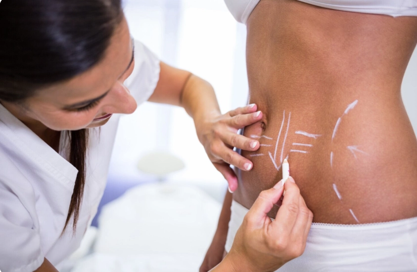 How Long Does It Take for Liposuction to Heal?