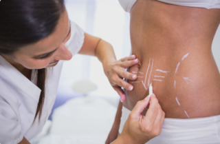 Quanto tempo ci vuole perché la liposuzione guarisca