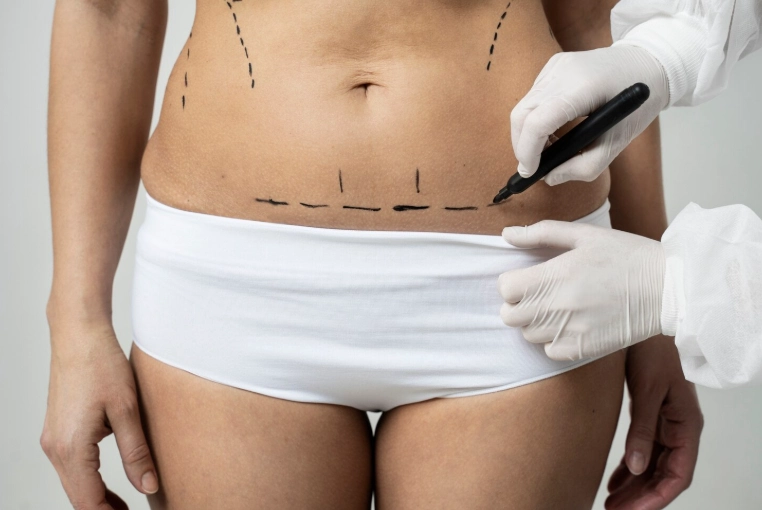 How Much Weight Can You Lose with Liposuction?