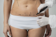 Câtă greutate poți pierde cu liposucția