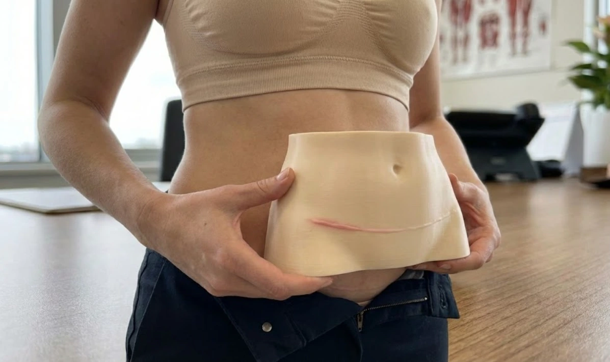 anatomical model showing tummy tuck scar placement