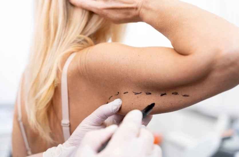 Arm Liposuction in Turkey: Slimmer Arms