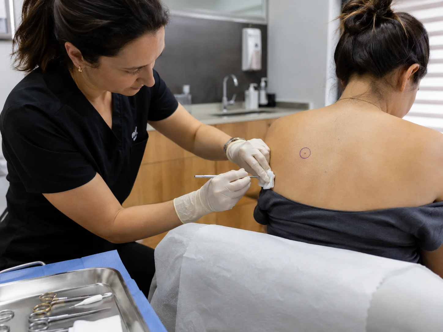 mole removal
