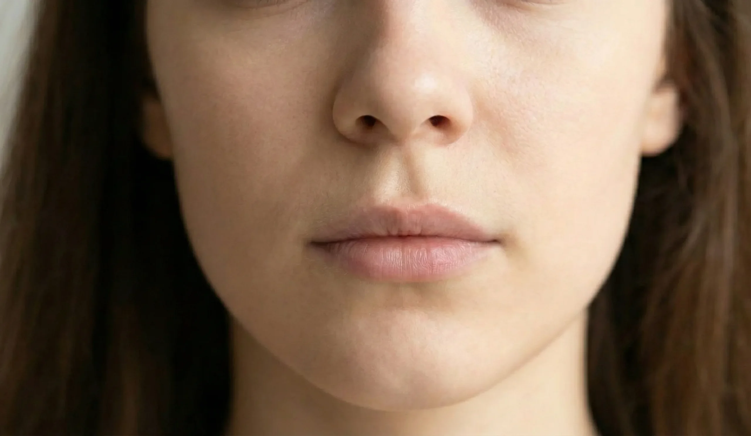 shorter philtrum and fuller upper lip after subnasal lip lift