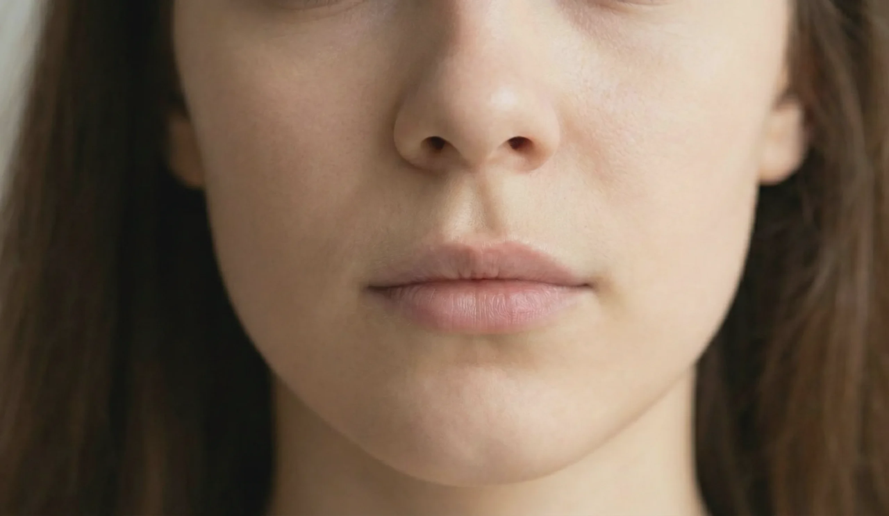 shorter philtrum and fuller upper lip after subnasal lip lift