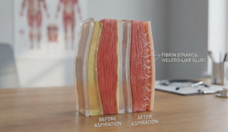 anatomical skin model vacuum seal seroma concept
