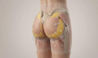 bbl anatomy greft compression model