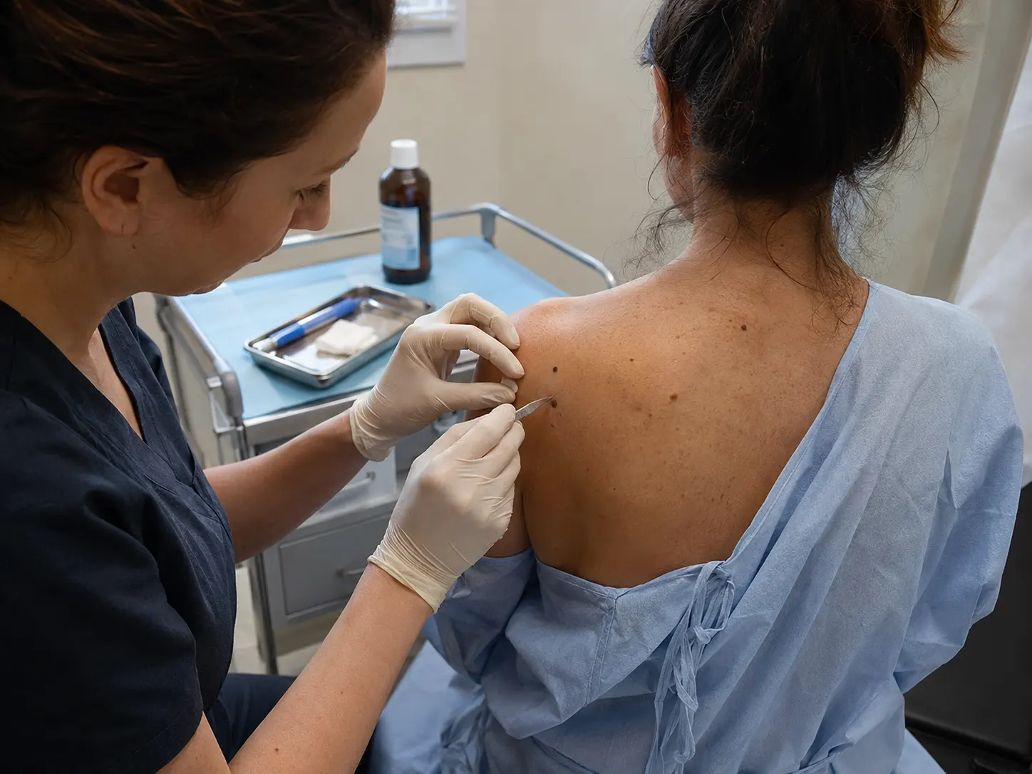 mole removal surgical back procedure