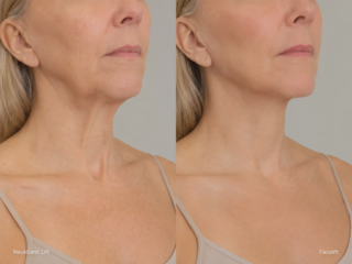 neck lift vs facelift neck profile comparison