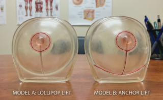 anatomical breast models lollipop vs anchor scars
