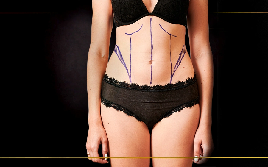 What Is Liposuction? Procedure, Benefits, Risks, and Recovery