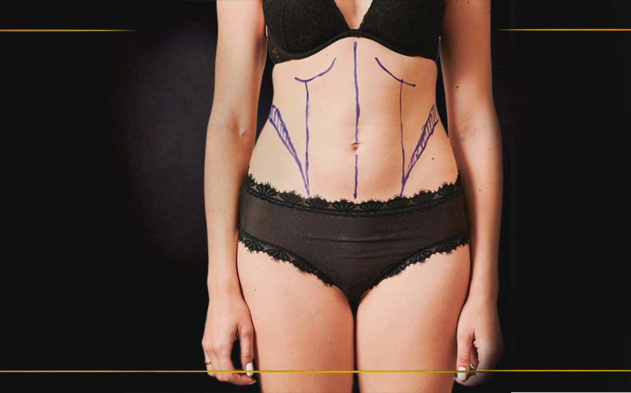 What Is Liposuction? Procedure, Benefits, Risks, and Recovery