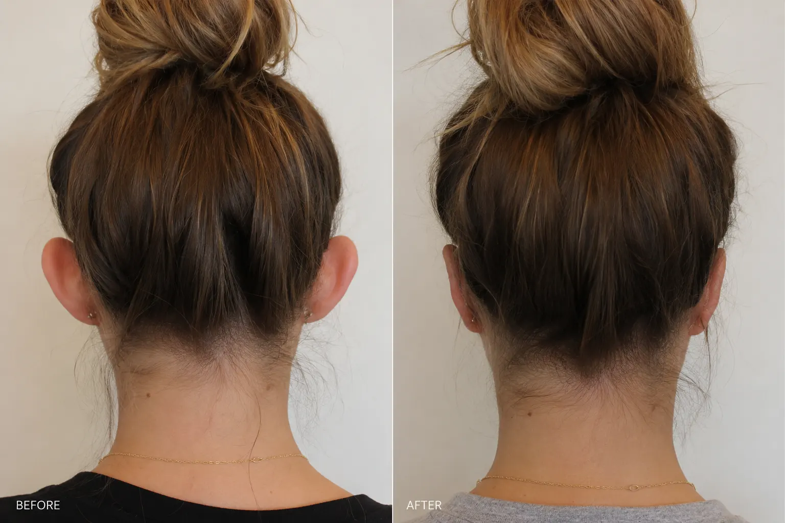 otoplasty before and after patient photo