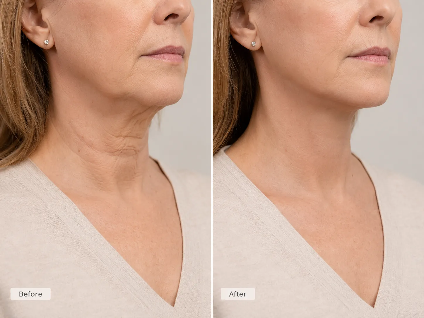 neck lift