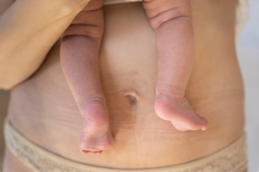 liposuction after pregnancy