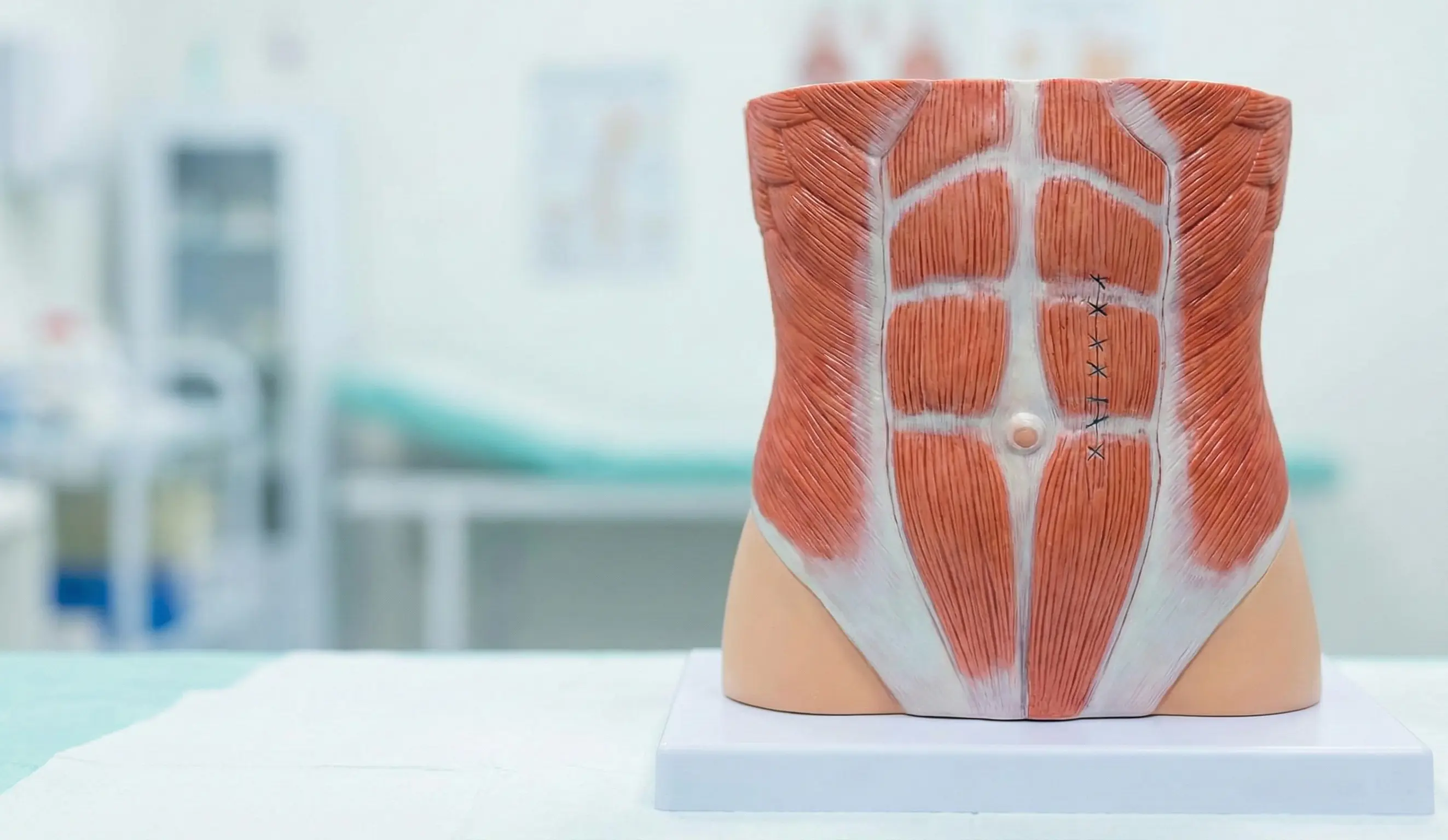 modello anatomico che mostra la riparazione della diastasi dei retti