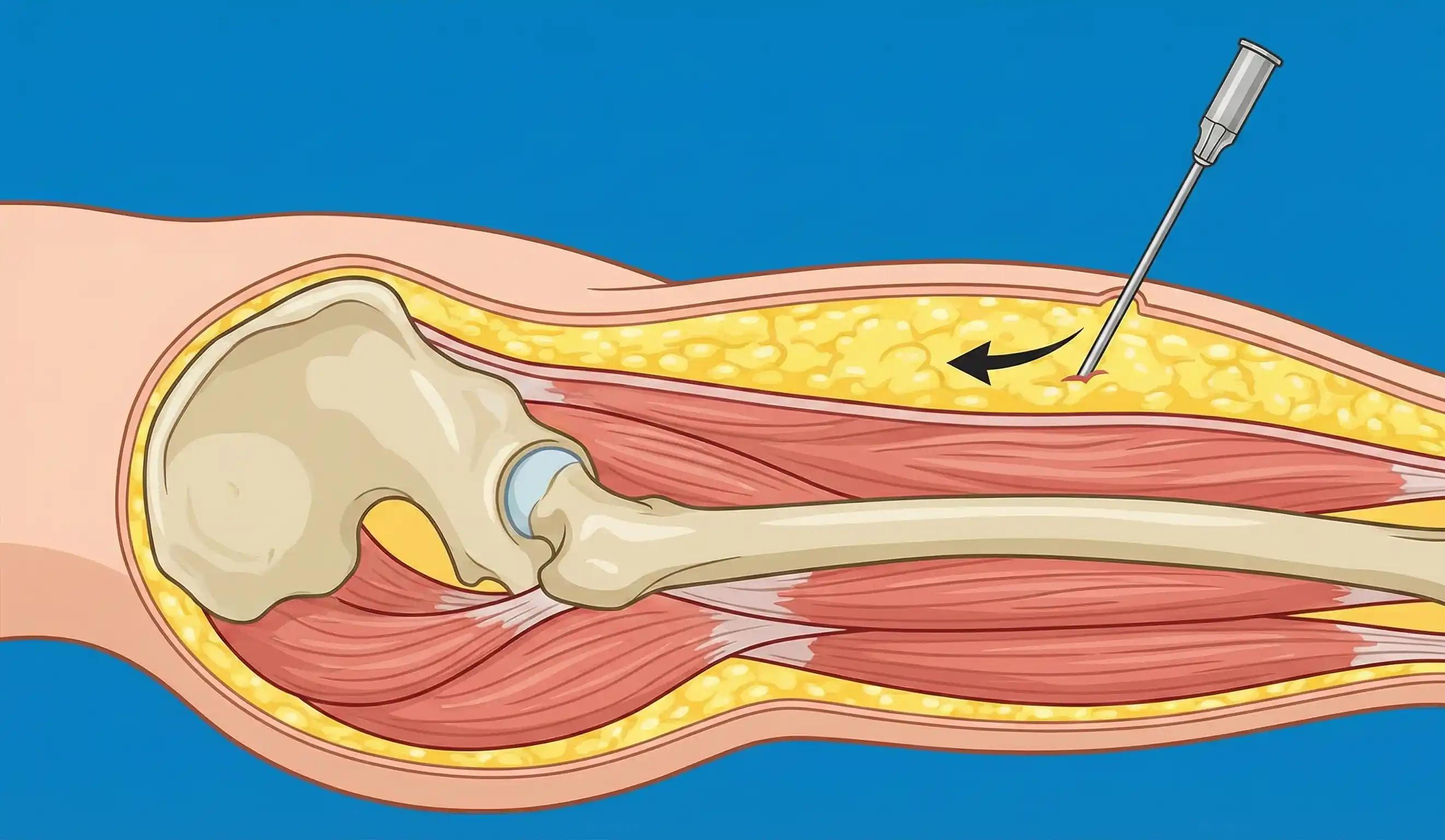 illustration medica sezione trasversale dell'anca che mostra la cannula di liposuzione che rimuove il grasso