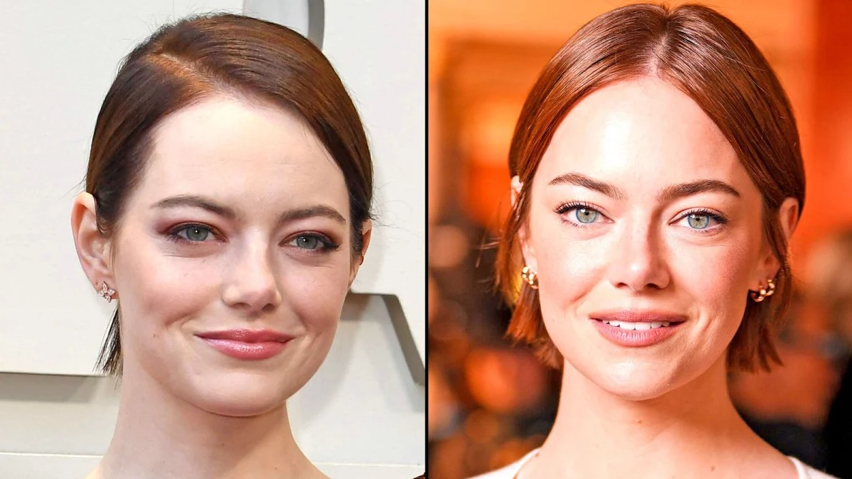 emma stones facelift