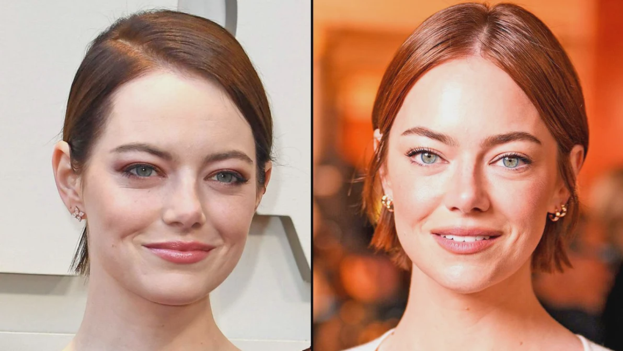 emma stones facelift