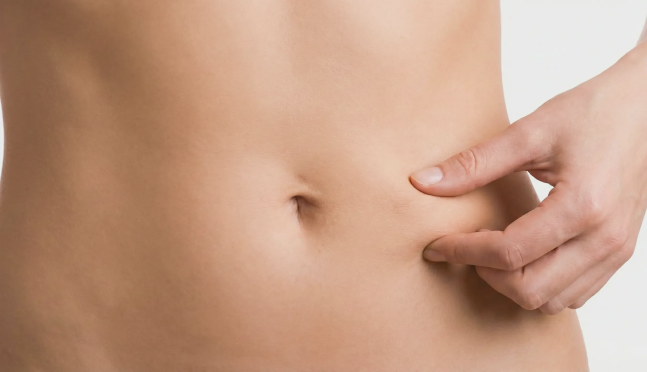 tightened stomach skin representing j plasma or laser assisted liposuction results