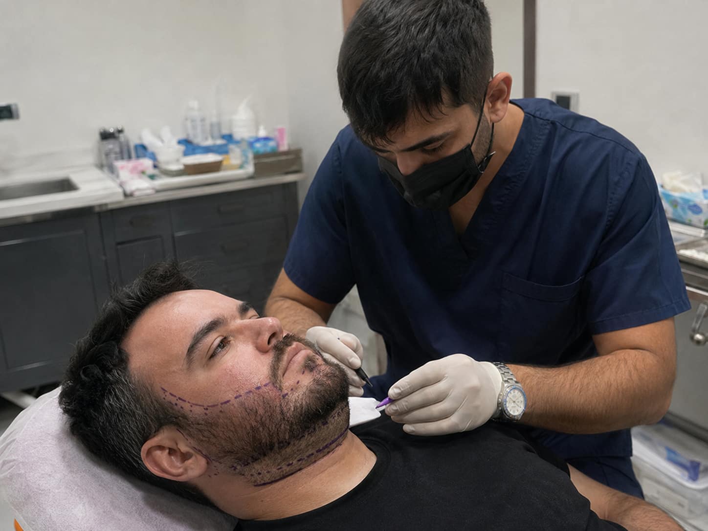 beard transplant procedure day