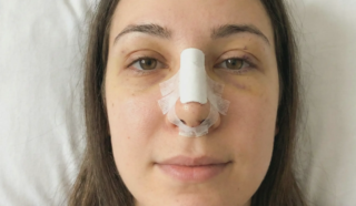 rhinoplasty early recovery patient with splint and tapes natural photo