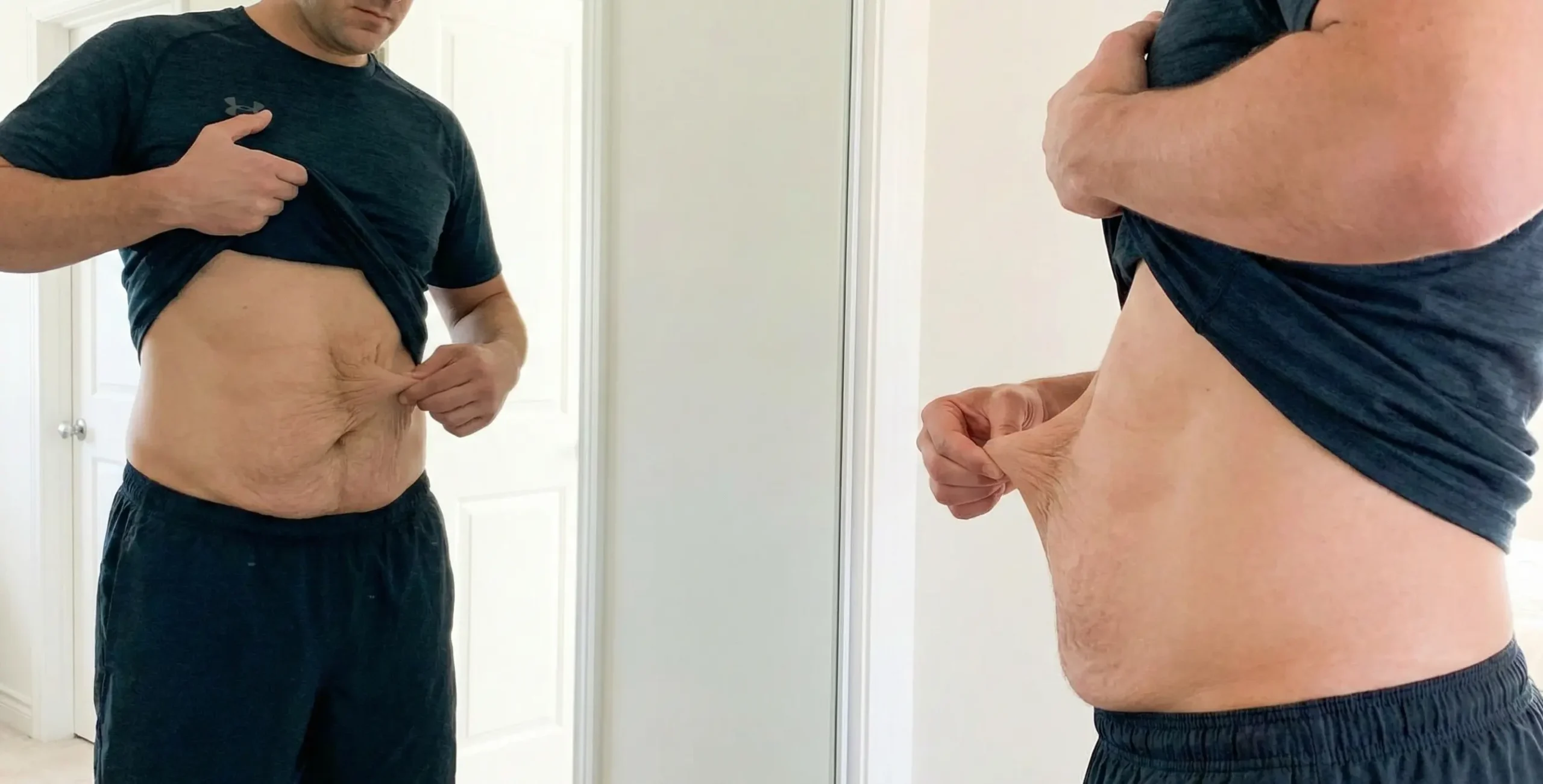 post weight loss vertical skin laxity