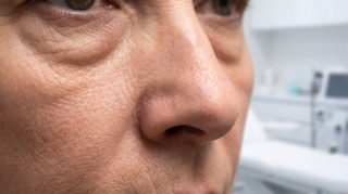 Midfacelift: Can a Midface Lift Fix Heavy Malar Bags?