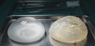 comparison of pristine new implant versus calcified explanted implant