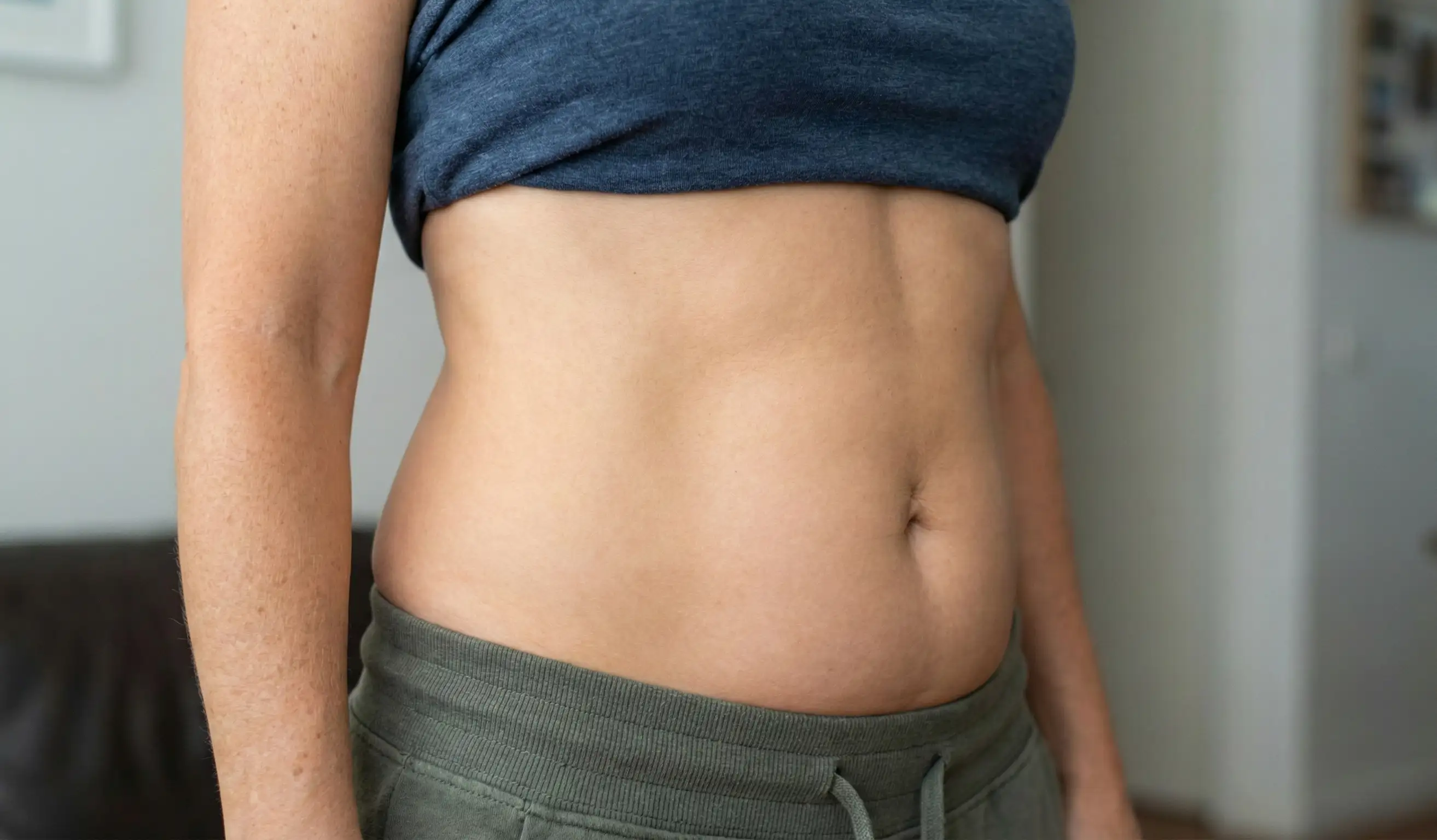 long term liposuction result with moderate weight gain