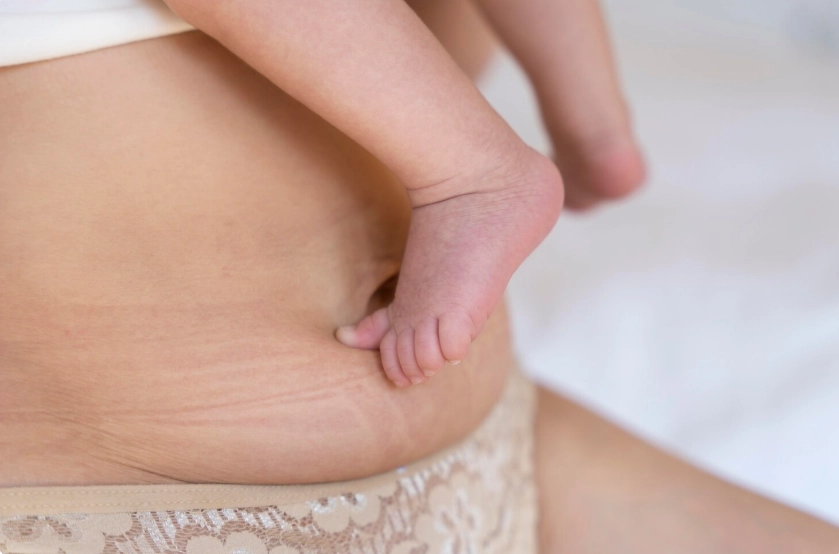 lipo after pregnancy