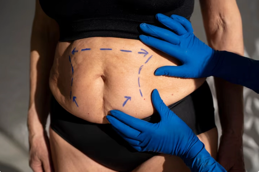Liposuction Belly: Slimmer and Toned Abdomen