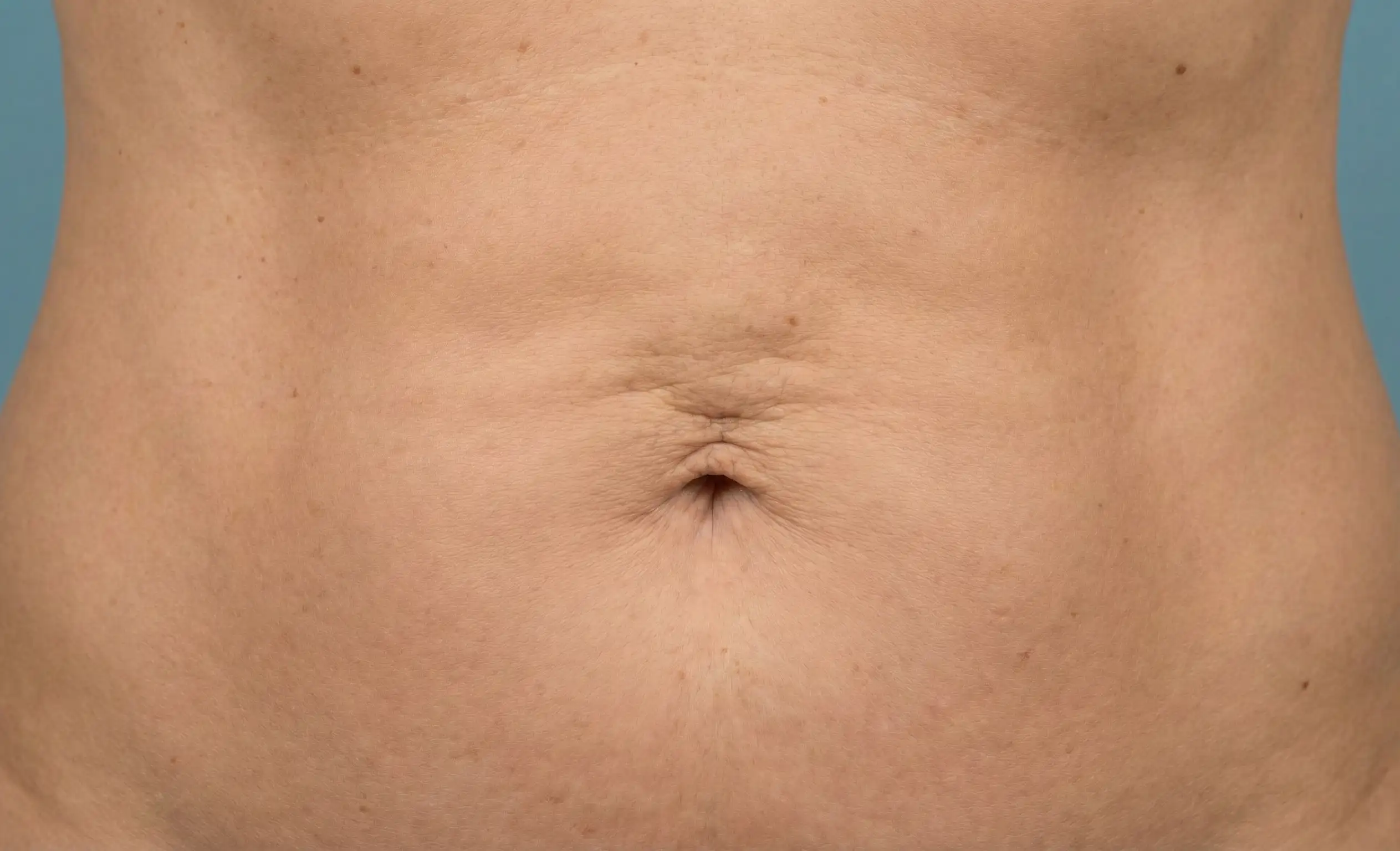 long term liposuction result affected by natural aging and skin laxity