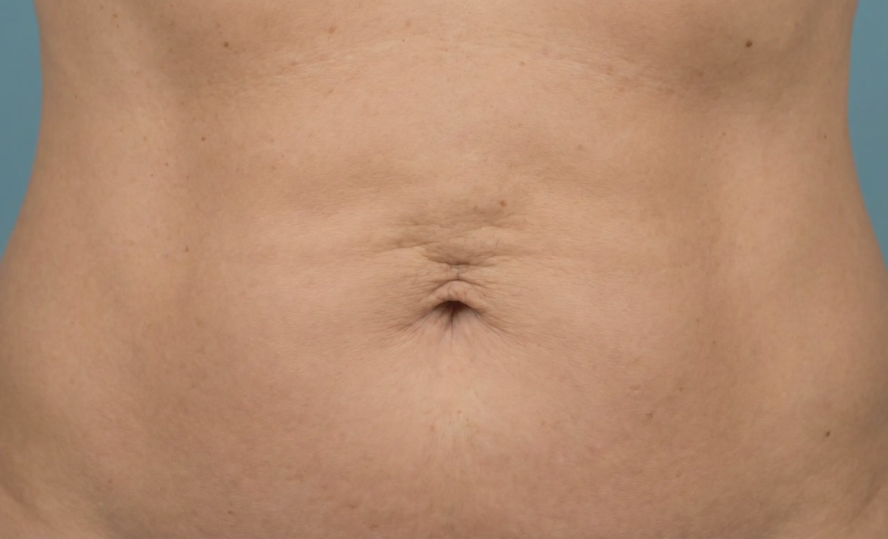 long term liposuction result affected by natural aging and skin laxity