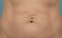long term liposuction result affected by natural aging and skin laxity