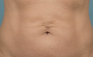 long term liposuction result affected by natural aging and skin laxity