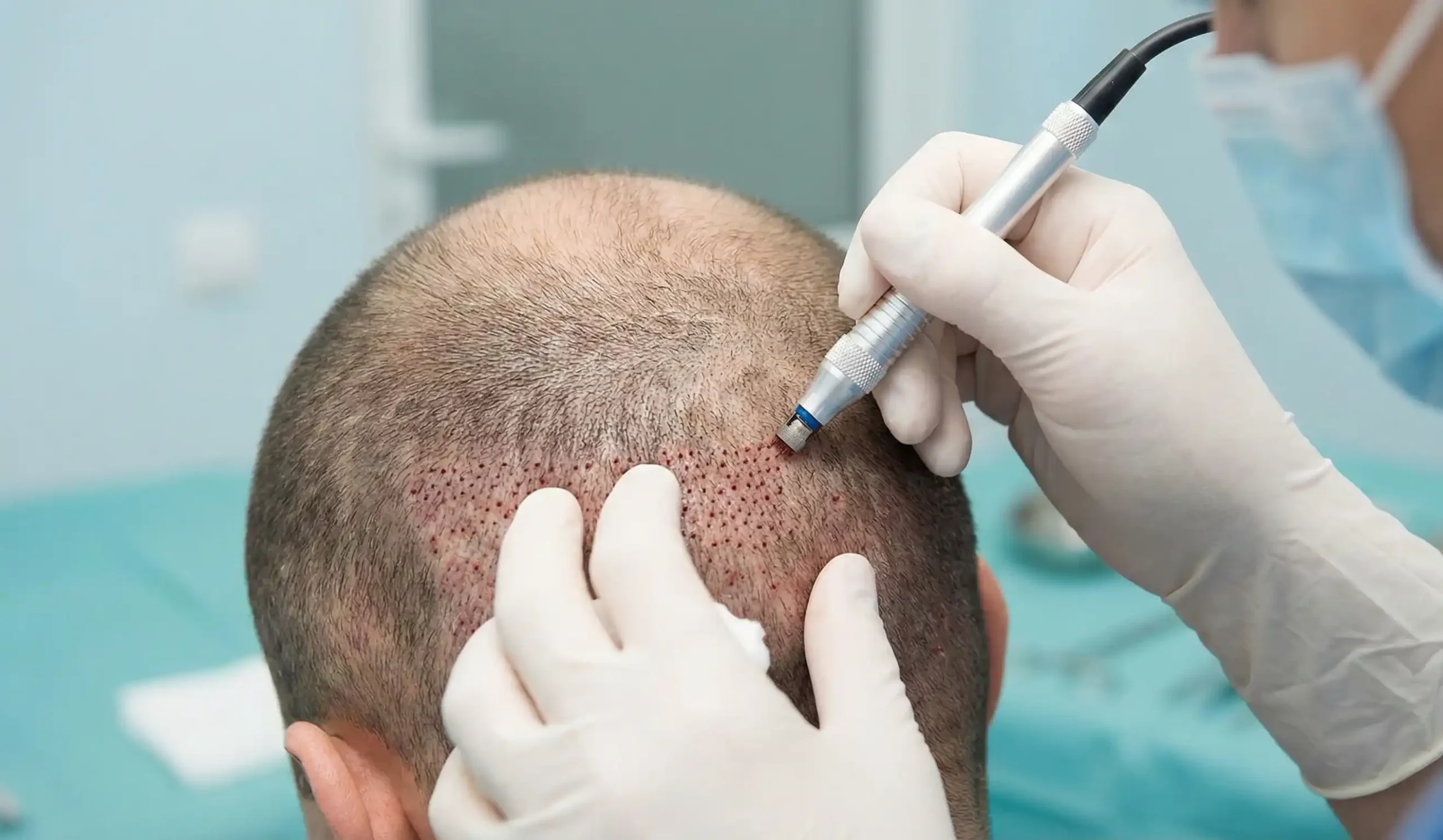 hair transplant surgical scalp trauma
