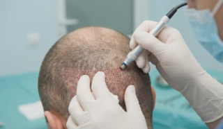 hair transplant surgical scalp trauma