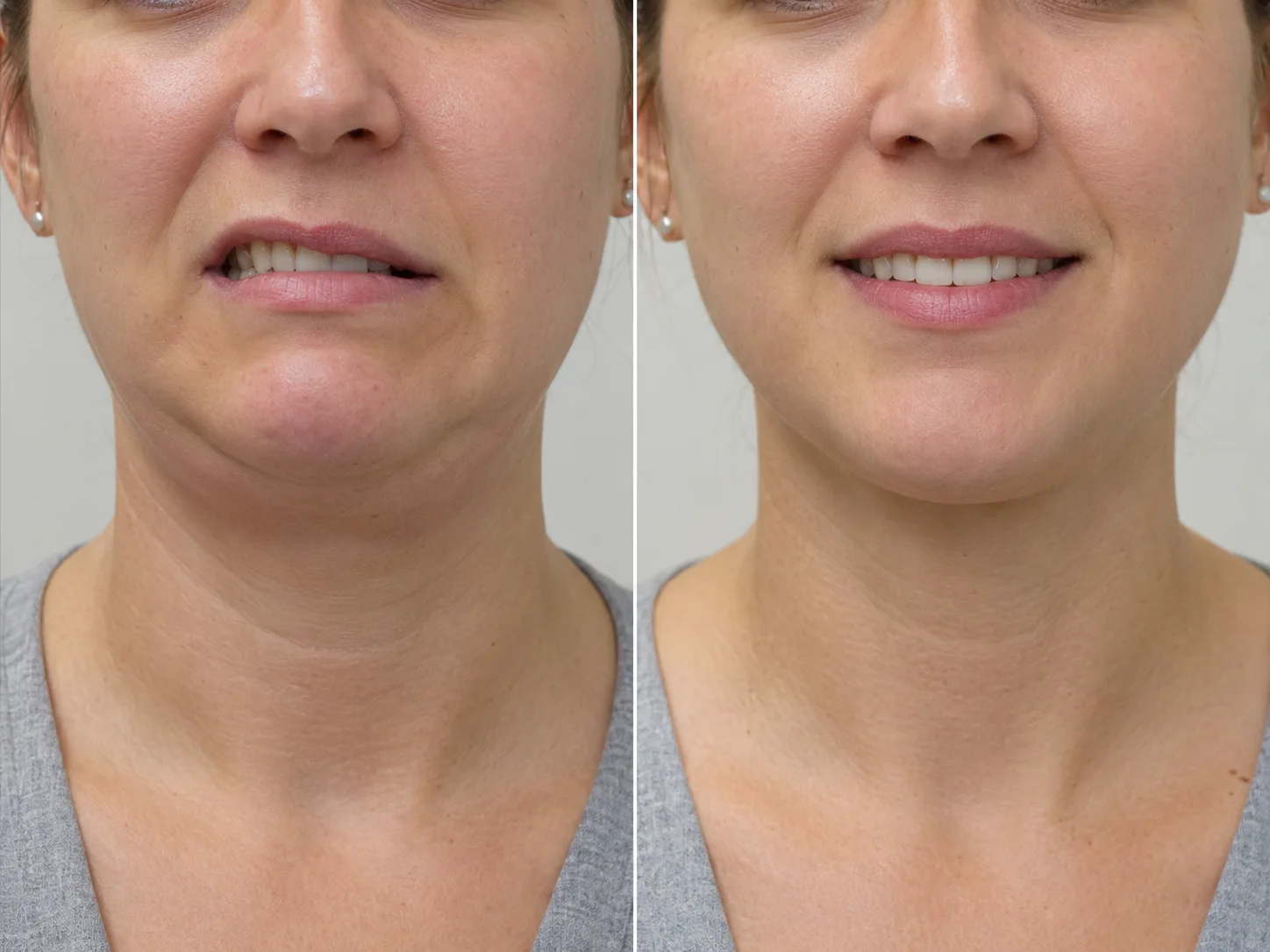 crooked smile after chin liposuction