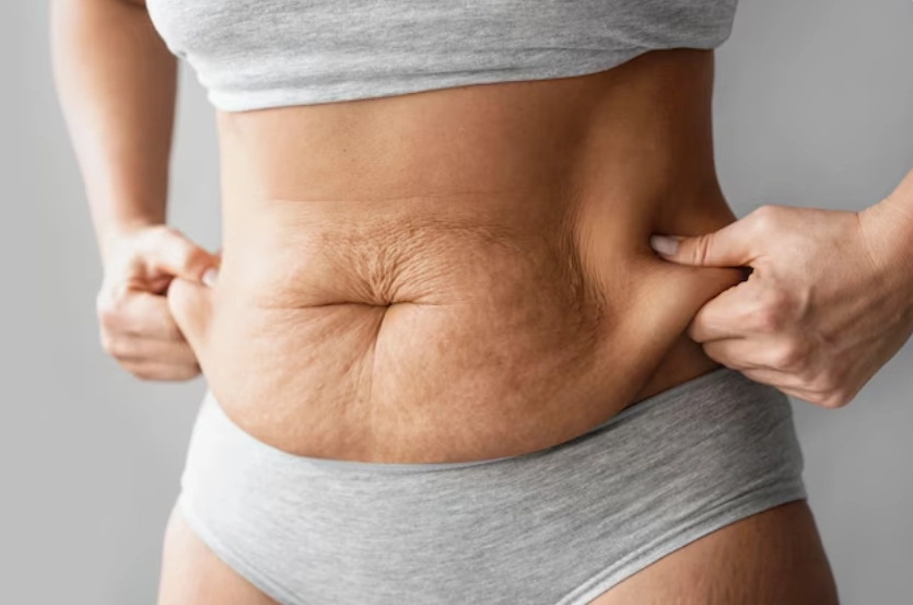 Lipoaspirație completă a corpului în Turcia