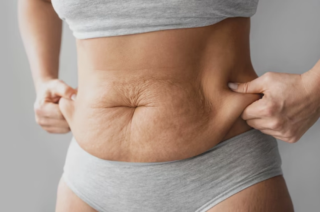 Liposuzione totale del corpo in Turchia